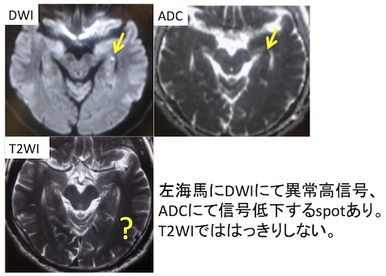 一過性全健忘のMRI画像診断 (TGA：transient global amnesia、海馬の